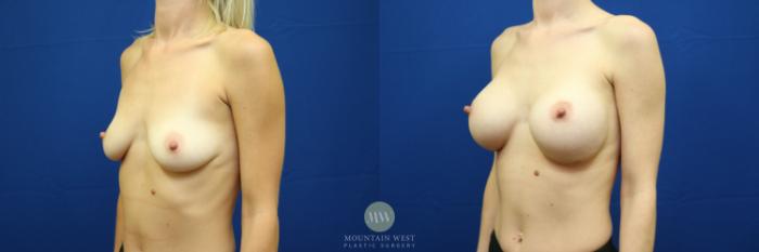 Before & After Breast Augmentation Case 41 View #2 View in Kalispell, MT