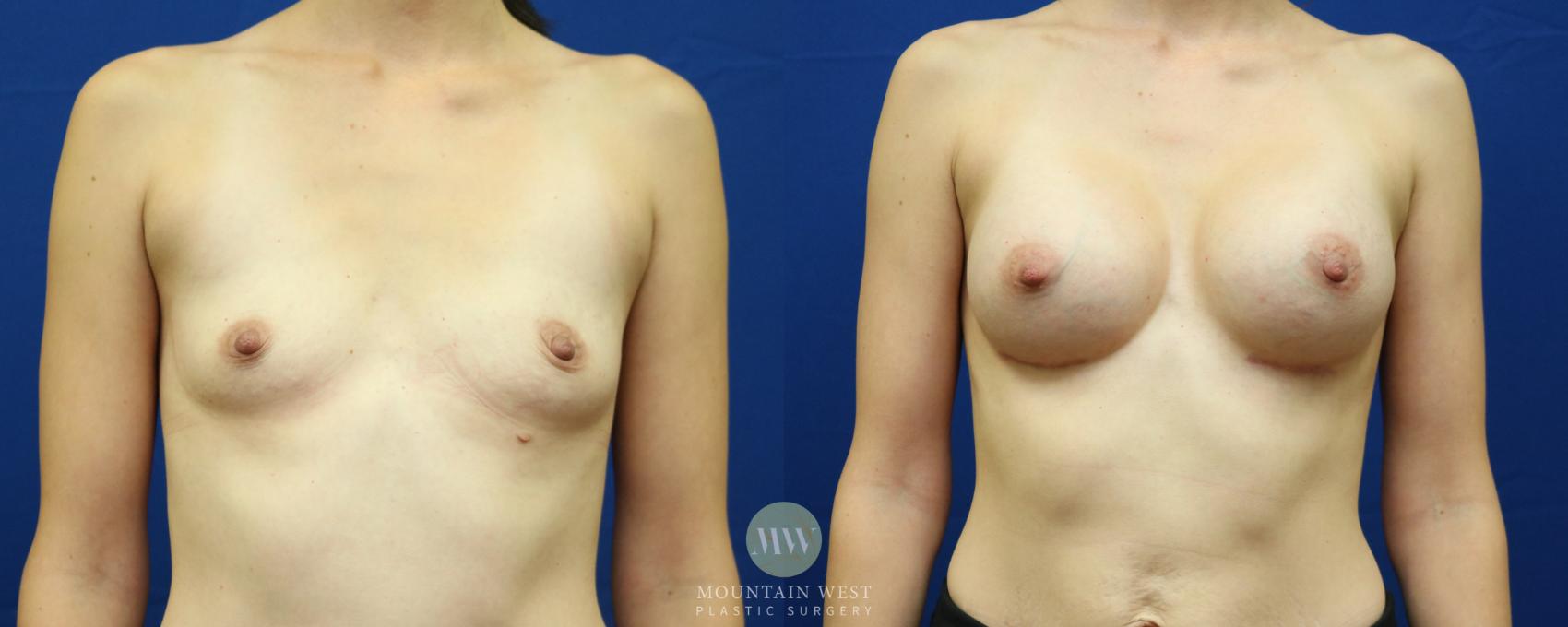 Breast Augmentation Case 54 Before & After View #1 | Kalispell, MT | Mountain West Plastic Surgery
