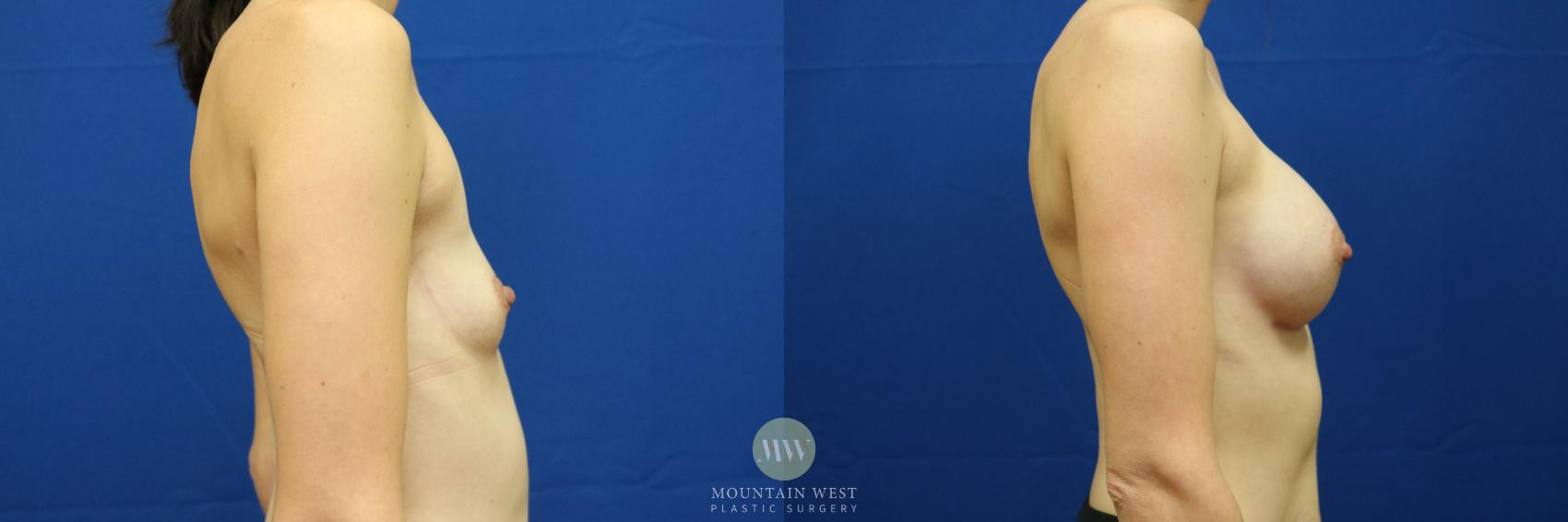 Breast Augmentation Case 54 Before & After View #2 | Kalispell, MT | Mountain West Plastic Surgery