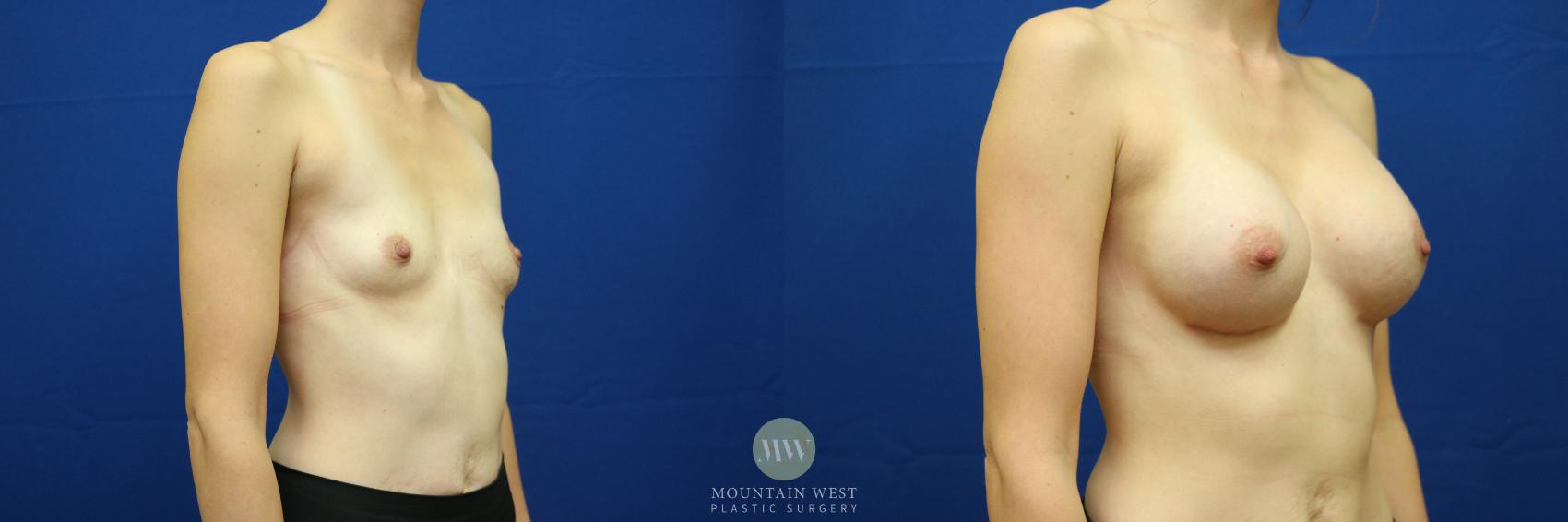 Breast Augmentation Case 54 Before & After View #3 | Kalispell, MT | Mountain West Plastic Surgery