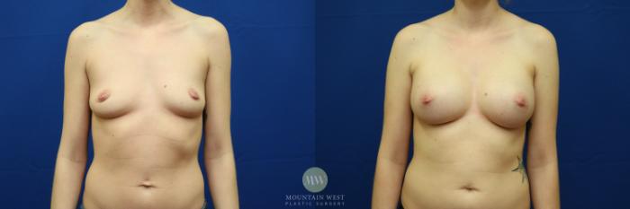 Before & After Breast Augmentation Case 57 View #1 View in Kalispell, MT