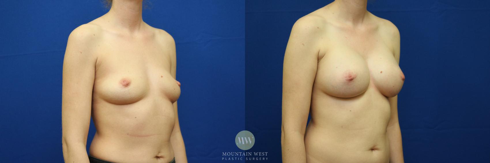 Breast Augmentation Case 57 Before & After View #2 | Kalispell, MT | Mountain West Plastic Surgery