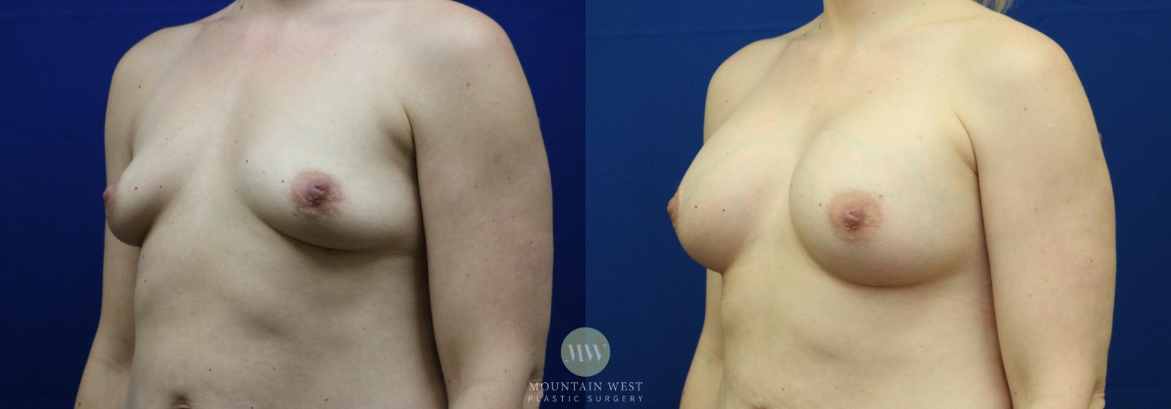 Breast Augmentation Case 59 Before & After View #1 | Kalispell, MT | Mountain West Plastic Surgery