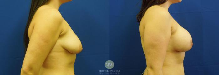 Before & After Breast Augmentation Case 6 View #2 View in Kalispell, MT