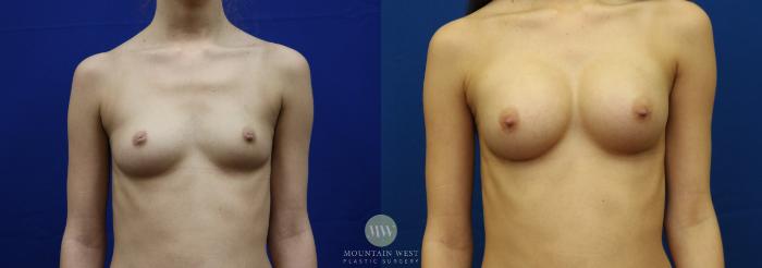Before & After Breast Augmentation Case 63 View #1 View in Kalispell, MT