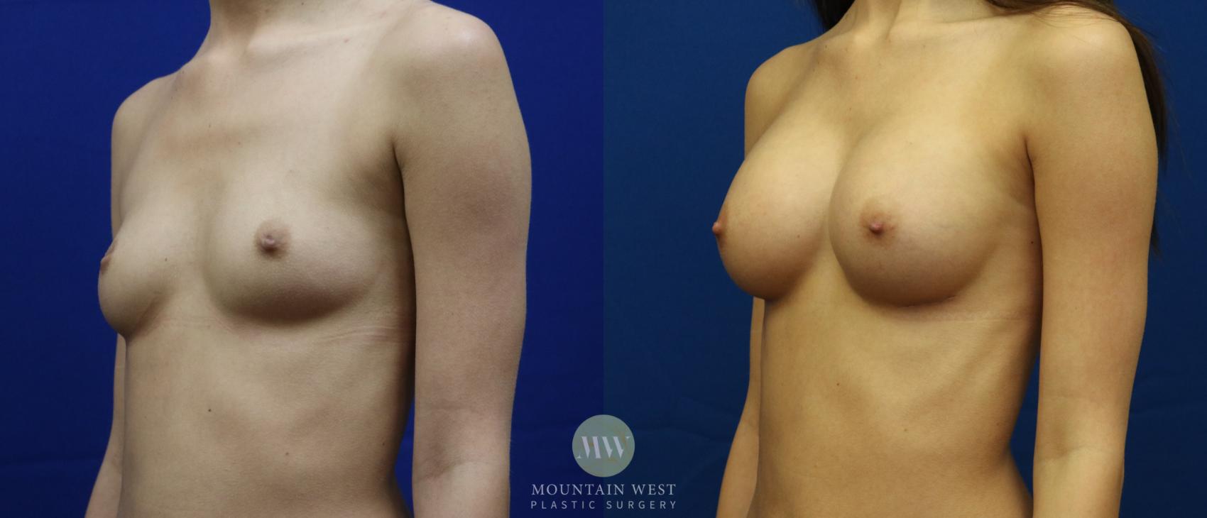 Breast Augmentation Case 63 Before & After View #2 | Kalispell, MT | Mountain West Plastic Surgery
