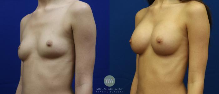 Before & After Breast Augmentation Case 63 View #2 View in Kalispell, MT