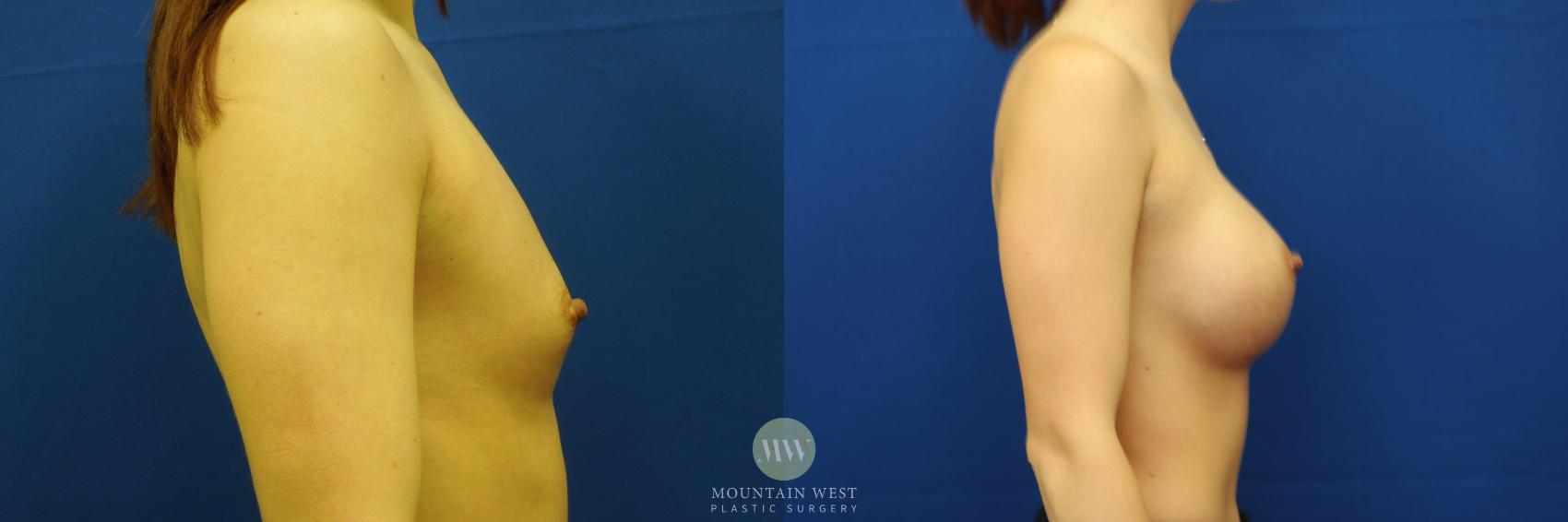 Breast Augmentation Case 69 Before & After View #1 | Kalispell, MT | Mountain West Plastic Surgery