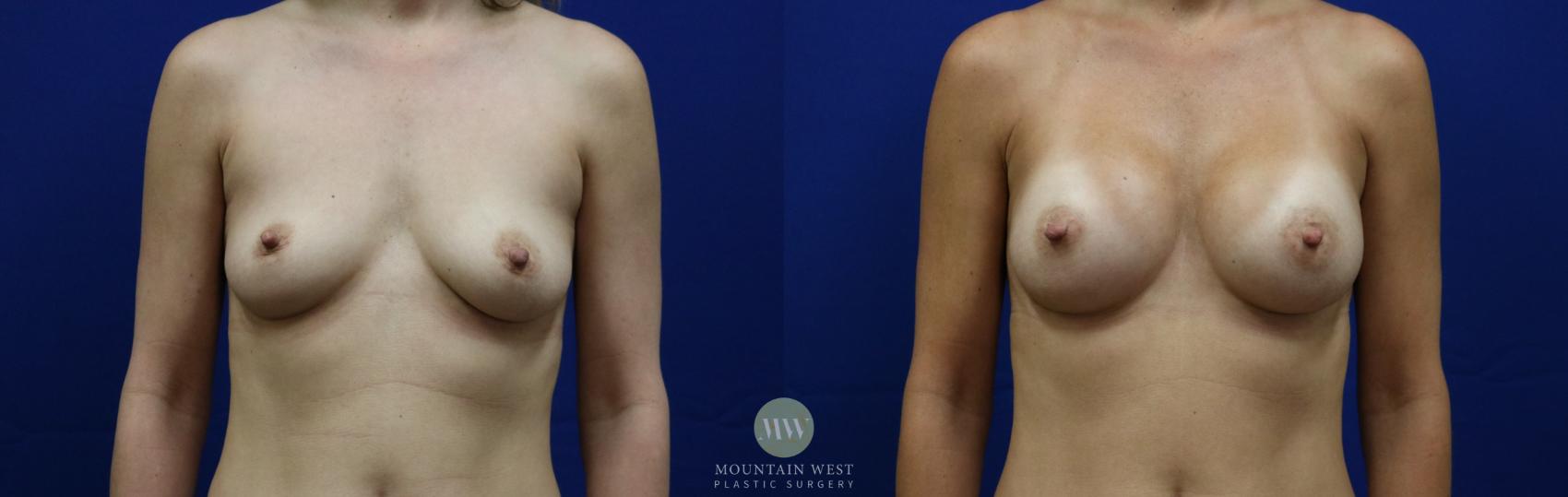Before & After Breast Augmentation Case 71 View #1 View in Kalispell, MT
