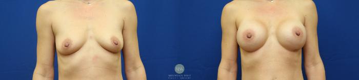 Before & After Breast Augmentation Case 73 View #2 View in Kalispell, MT