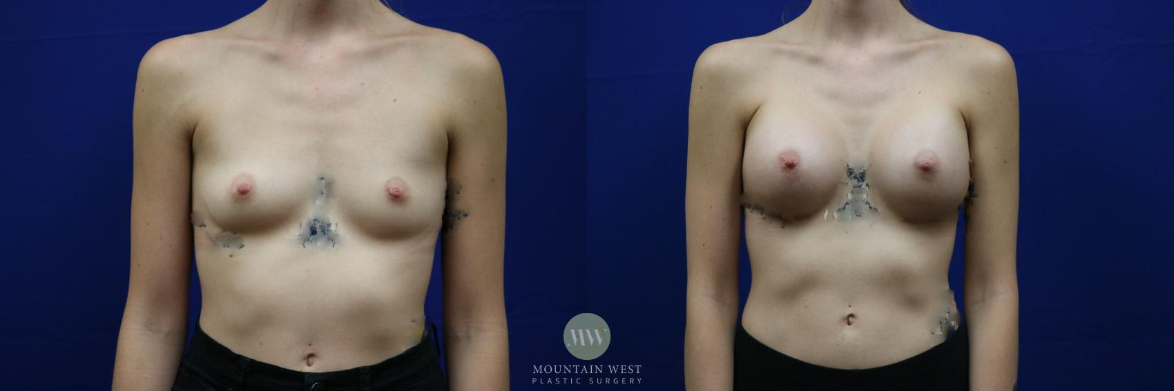 Before & After Breast Augmentation Case 80 View #1 View in Kalispell, MT
