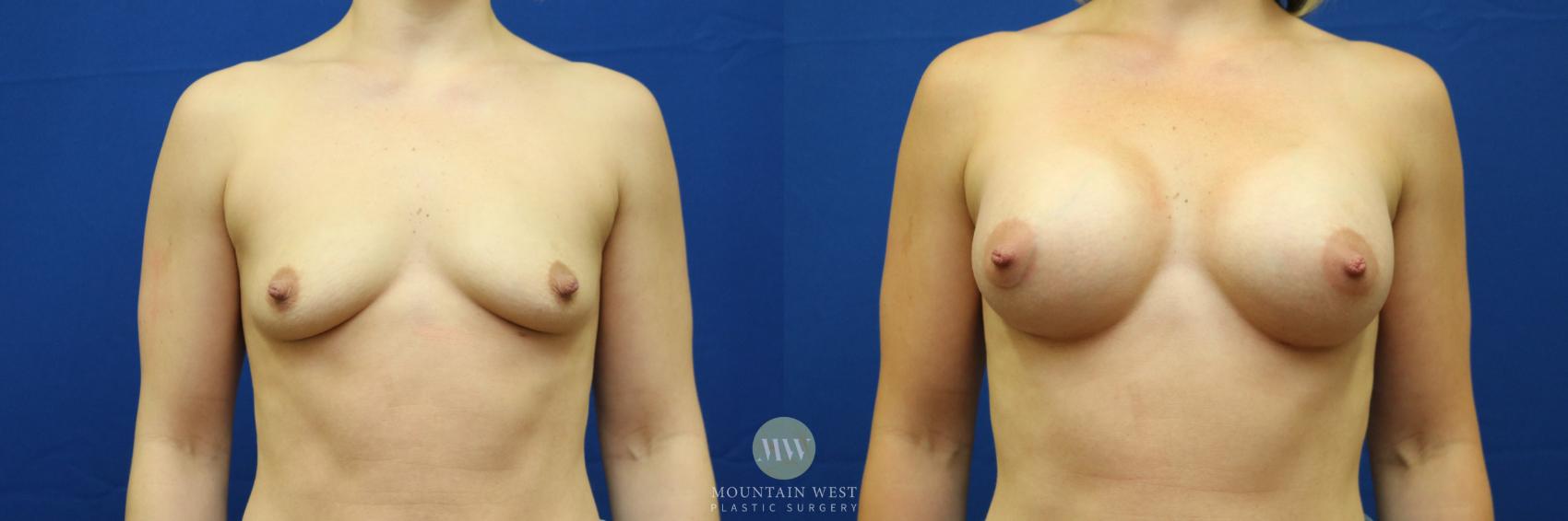 Breast Augmentation Case 83 Before & After View #1 | Kalispell, MT | Mountain West Plastic Surgery