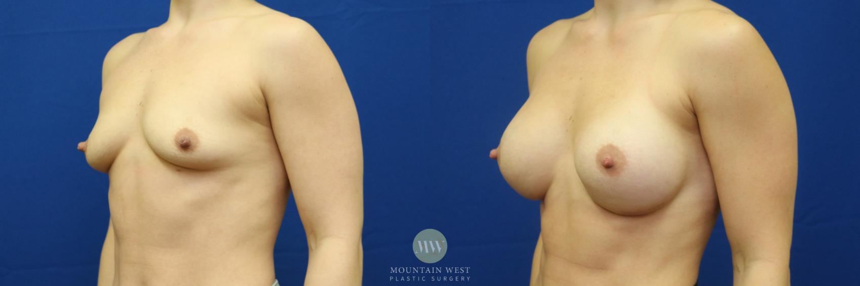 Breast Augmentation Case 83 Before & After View #2 | Kalispell, MT | Mountain West Plastic Surgery