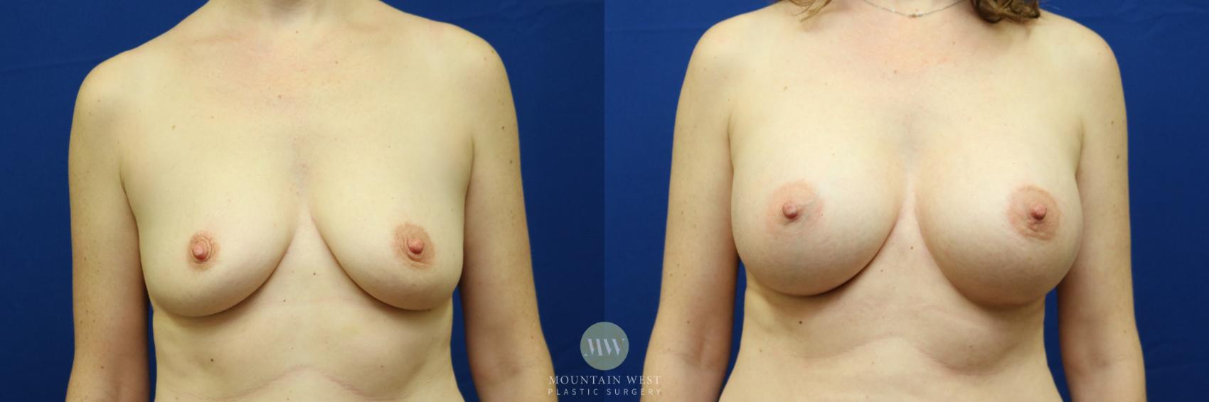 Before & After Breast Augmentation Case 84 View #1 View in Kalispell, MT