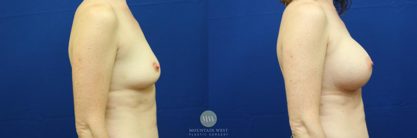 Breast Augmentation Case 84 Before & After View #2 | Kalispell, MT | Mountain West Plastic Surgery