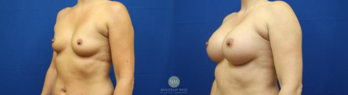 Before & After Breast Augmentation Case 86 View #1 View in Kalispell, MT