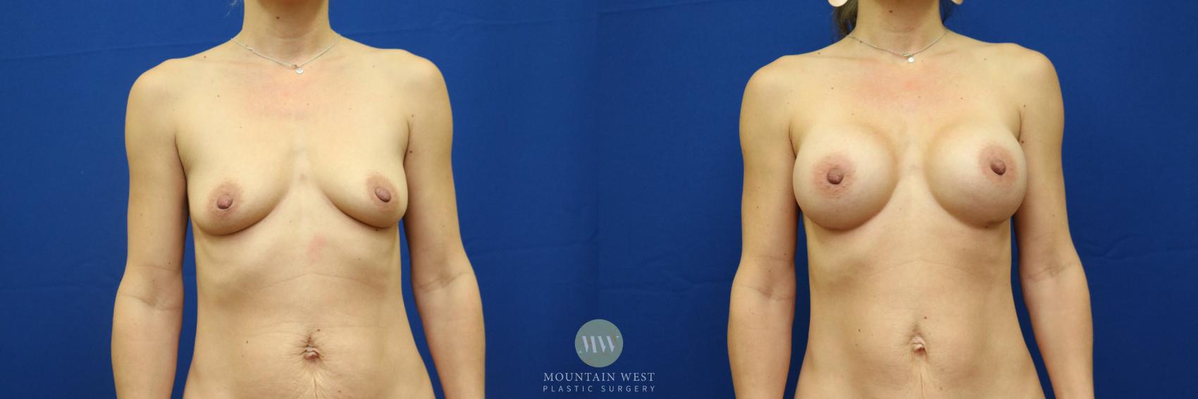 Breast Augmentation Case 87 Before & After View #1 | Kalispell, MT | Mountain West Plastic Surgery