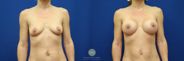 Before & After Breast Augmentation Case 87 View #1 View in Kalispell, MT