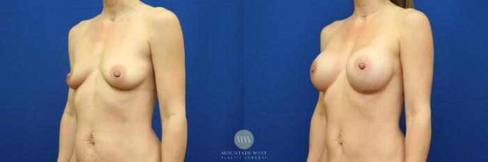 Before & After Breast Augmentation Case 87 View #2 View in Kalispell, MT