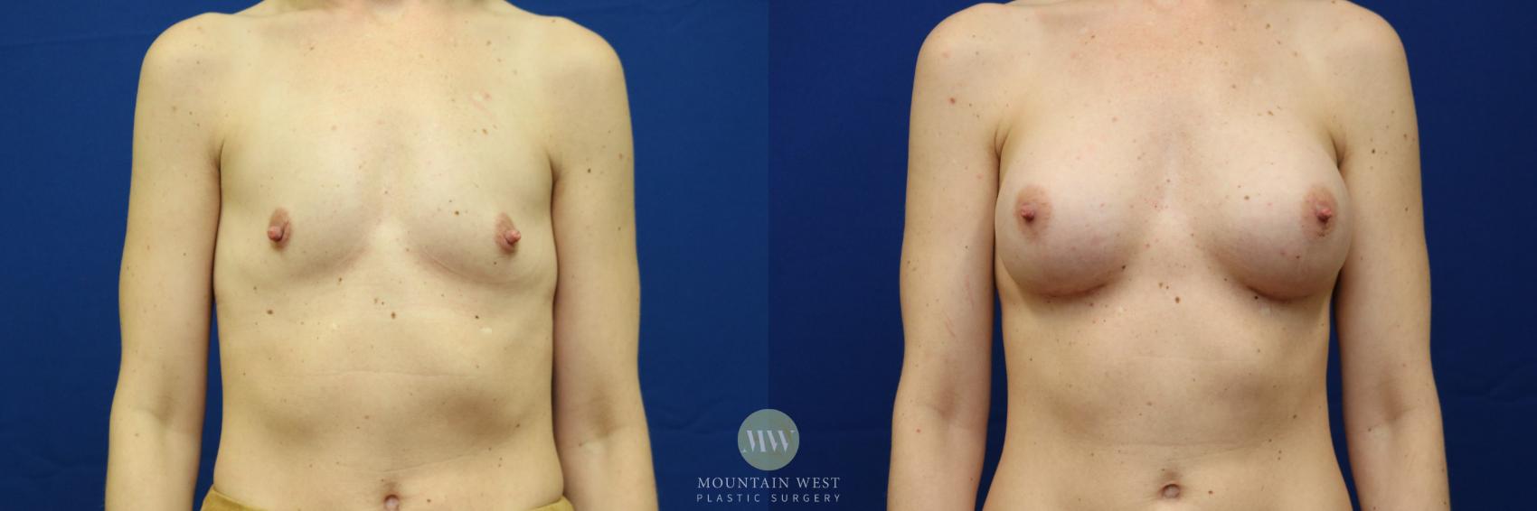 Before & After Breast Augmentation Case 89 View #1 View in Kalispell, MT