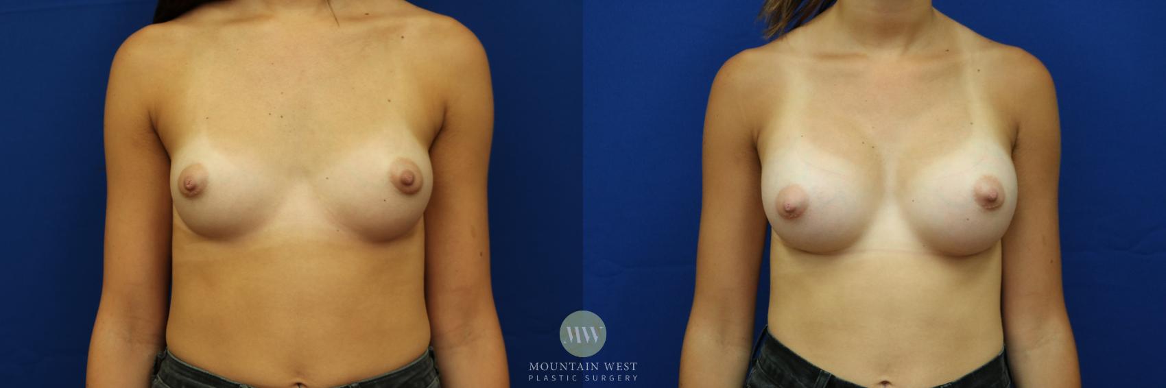 Breast Augmentation Case 9 Before & After View #1 | Kalispell, MT | Mountain West Plastic Surgery