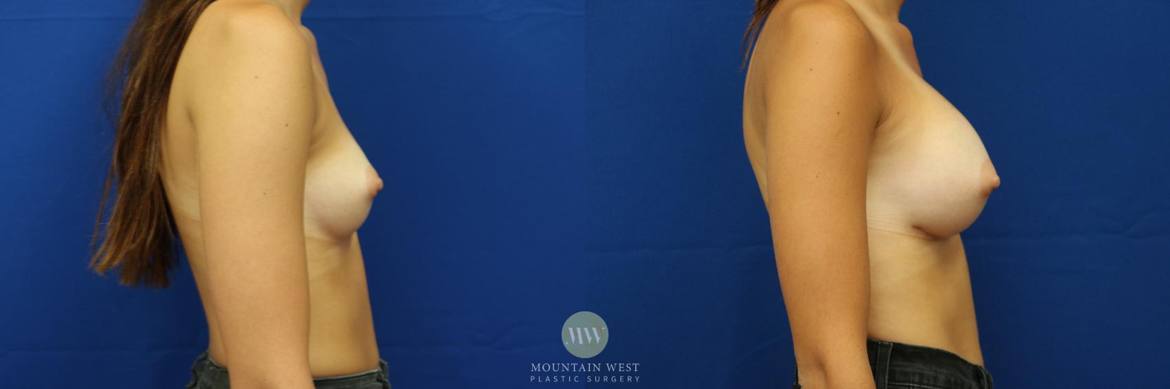 Breast Augmentation Case 9 Before & After View #2 | Kalispell, MT | Mountain West Plastic Surgery