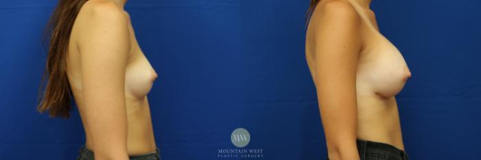 Before & After Breast Augmentation Case 9 View #2 View in Kalispell, MT