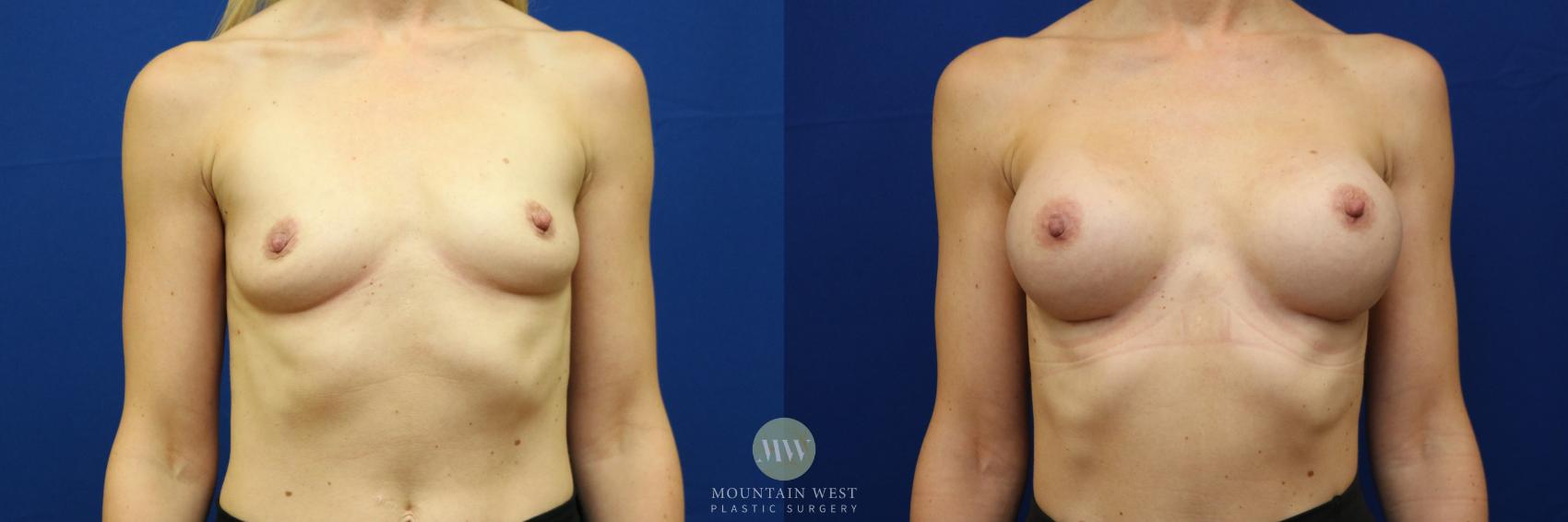 Before & After Breast Augmentation Case 90 View #1 View in Kalispell, MT