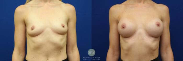 Before & After Breast Augmentation Case 90 View #1 View in Kalispell, MT