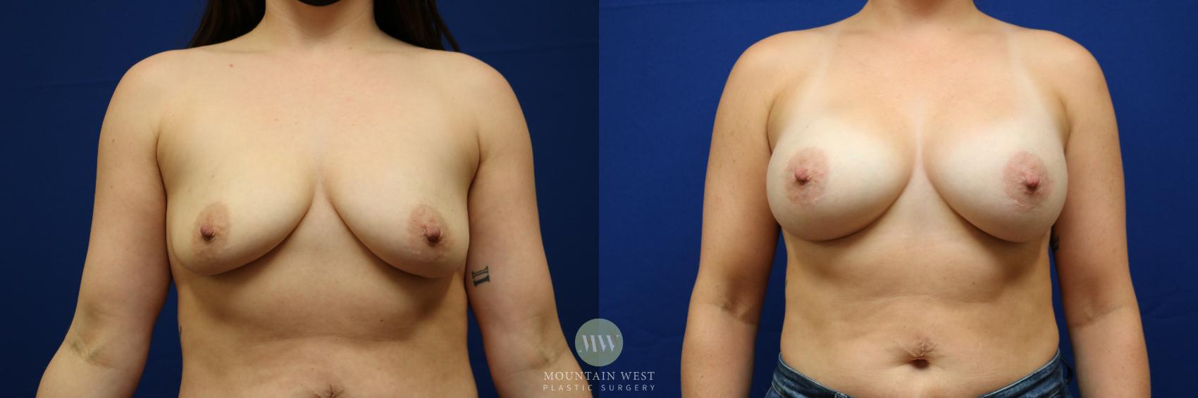Breast Augmentation Case 94 Before & After Front | Kalispell, MT | Mountain West Plastic Surgery