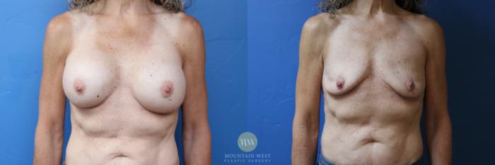 Before & After Breast Implant Removal  Case 182 Front View in Kalispell, MT