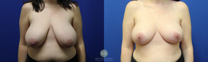 Before & After Breast Lift Case 116 Front View in Kalispell, MT