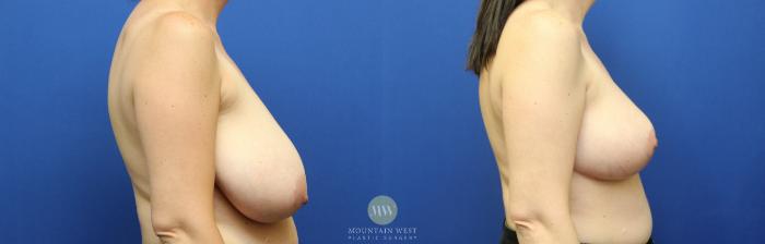 Before & After Breast Reduction Case 116 Right Side View in Kalispell, MT