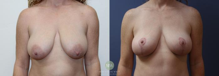 Before & After Breast Lift Case 150 Front View in Kalispell, MT