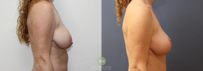 Before & After Breast Lift Case 150 Right Side View in Kalispell, MT