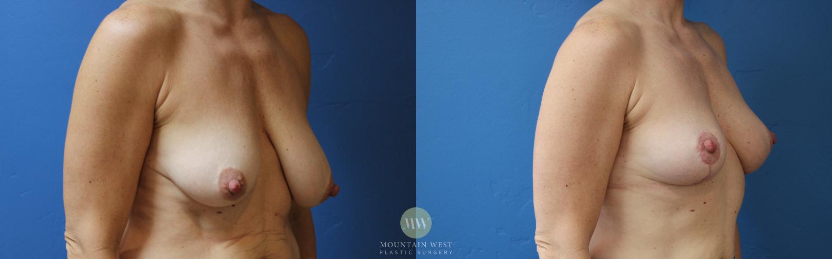 Before & After Breast Reduction Case 164 Right Oblique View in Kalispell, MT