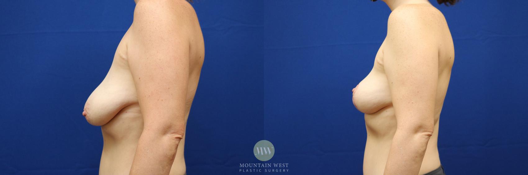 Breast Lift Case 99 Before & After Left Side | Kalispell, MT | Mountain West Plastic Surgery