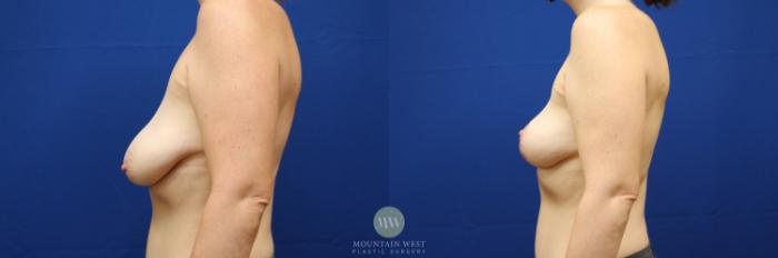 Before & After Breast Lift Case 99 Left Side View in Kalispell, MT