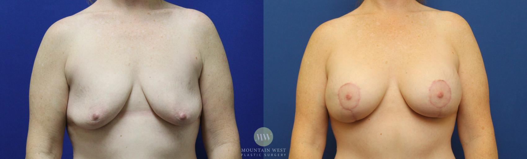 Breast Lift with Augmentation 