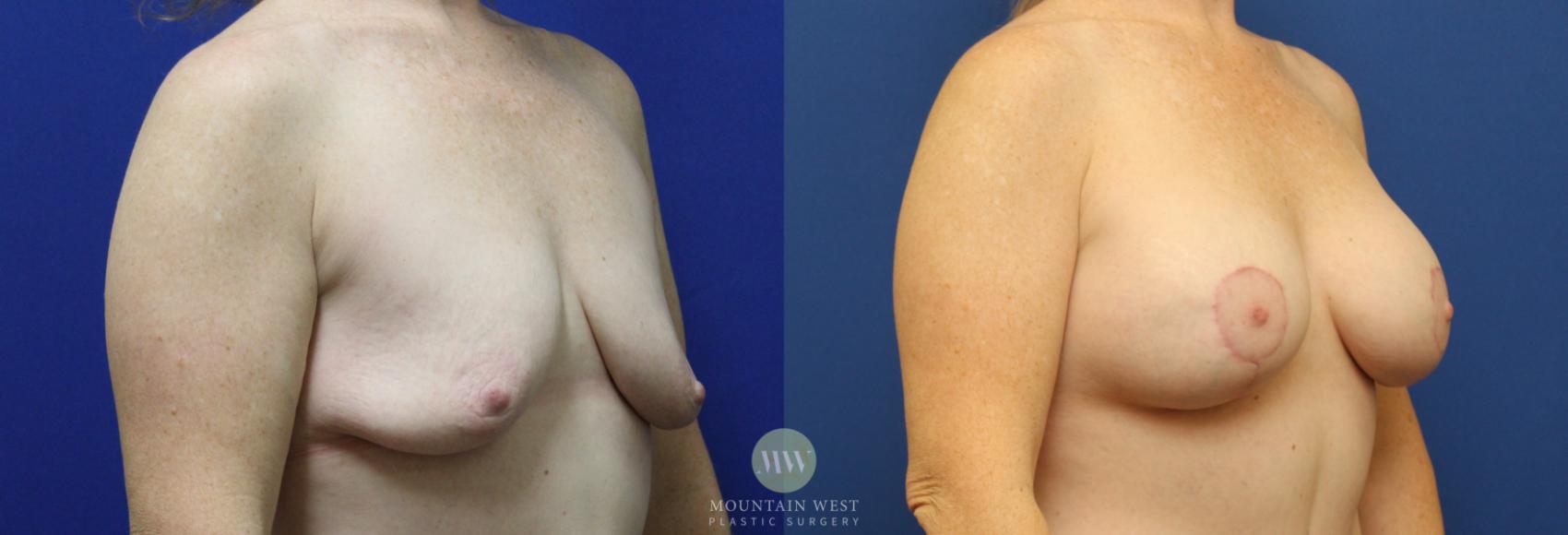 Breast Lift with Augmentation 