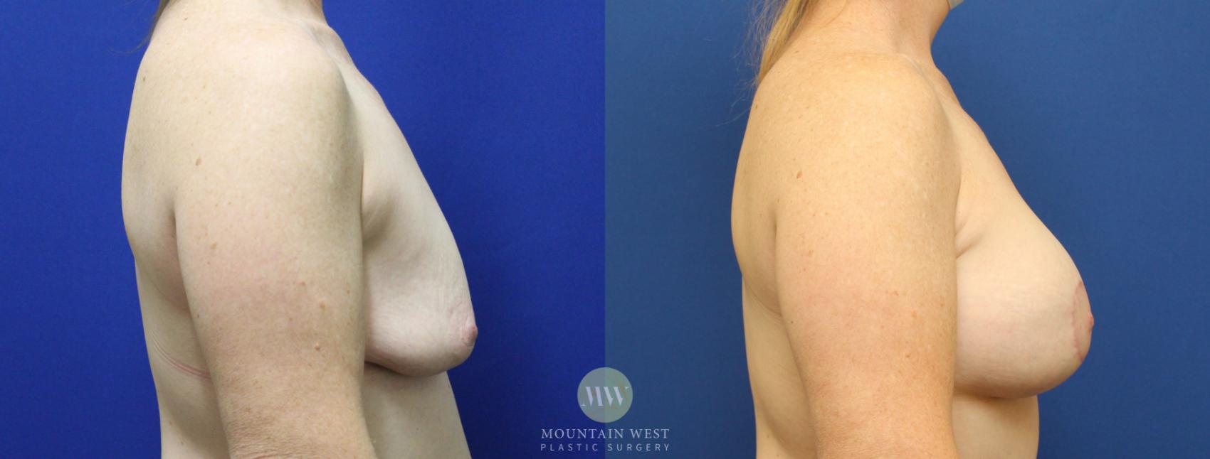 Breast Lift with Augmentation 