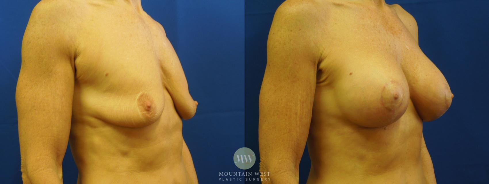 Before & After Breast Lift with Augmentation Case 15 View #1 View in Kalispell, MT