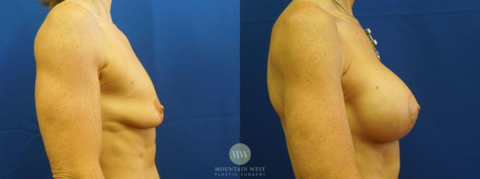 Before & After Breast Lift with Augmentation Case 15 View #2 View in Kalispell, MT