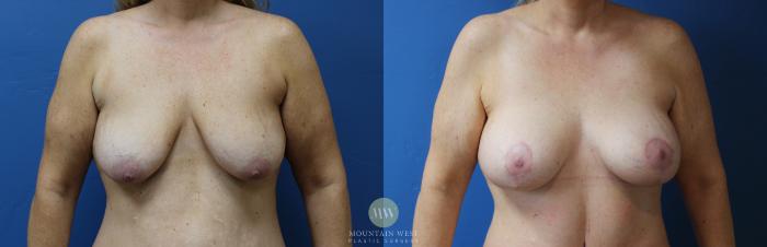 Before & After Breast Lift with Augmentation Case 152 Front View in Kalispell, MT