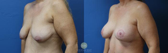 Before & After Breast Lift with Augmentation Case 152 Left Oblique View in Kalispell, MT