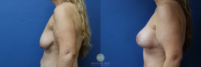 Before & After Breast Lift with Augmentation Case 152 Left Side View in Kalispell, MT