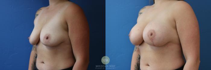 Before & After Breast Lift with Augmentation Case 156 Left Oblique View in Kalispell, MT