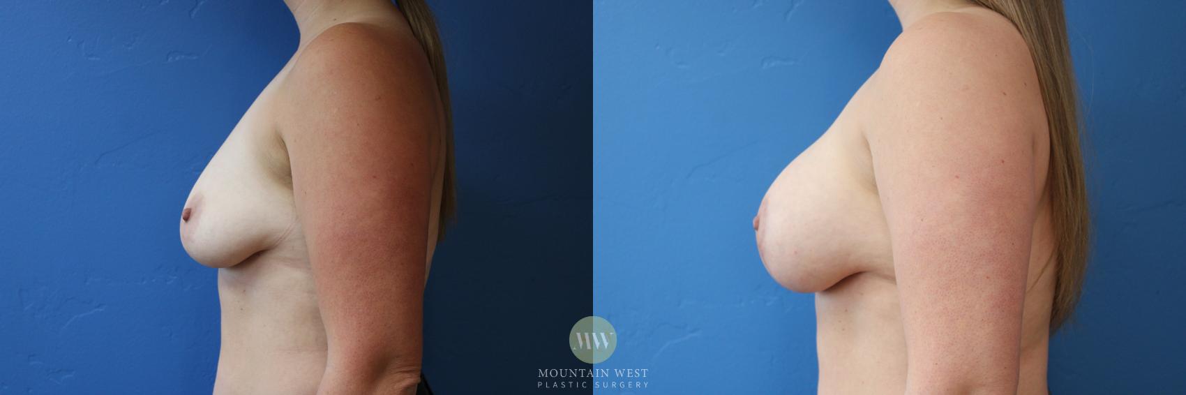 Before & After Breast Lift with Augmentation Case 156 Left Side View in Kalispell, MT