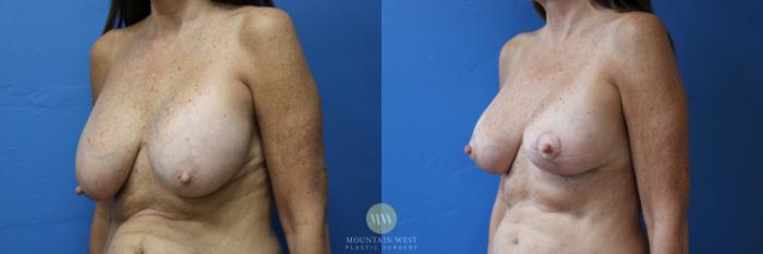 Before & After Breast Implant Removal  Case 163 Left Oblique View in Kalispell, MT