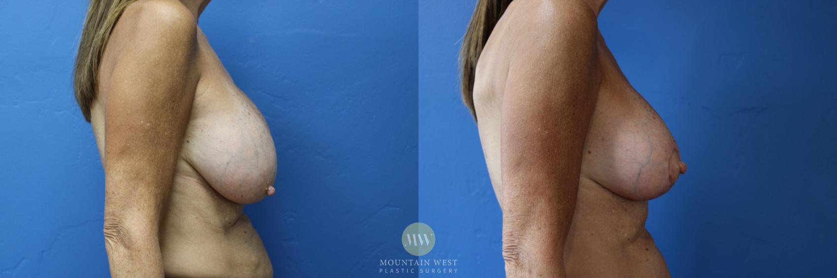 Before & After Breast Augmentation Case 163 Right Side View in Kalispell, MT